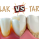 plak vs tartar, plak nedir, tartar nedir