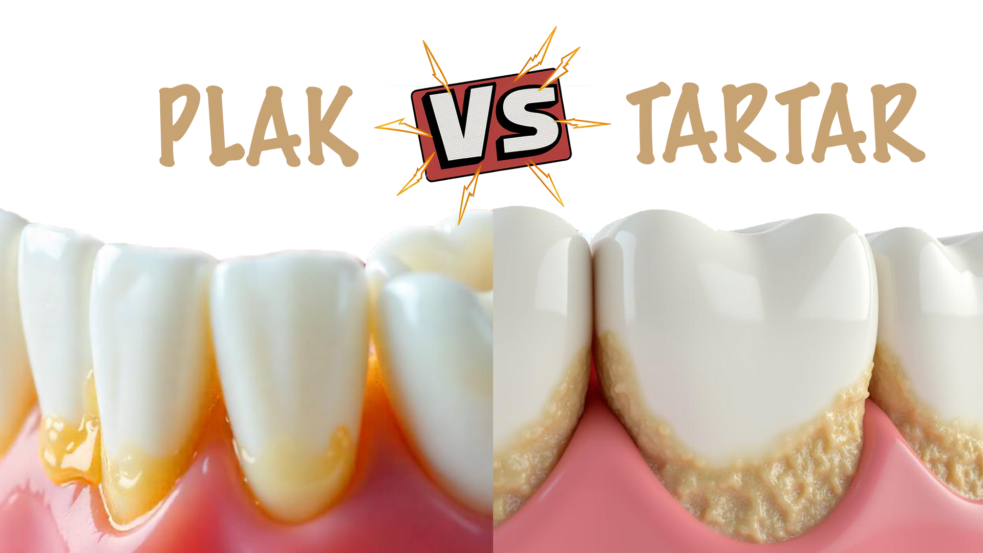 plak vs tartar, plak nedir, tartar nedir