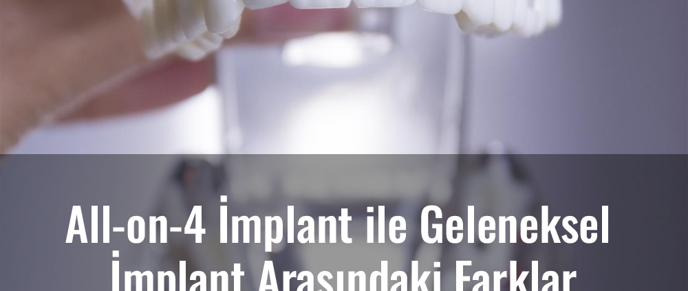 all-on-4 implant