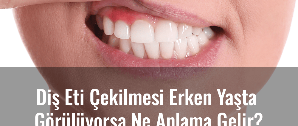 diş eti çekilmesi erken yaşta görülüyorsa ne anlama gelir? Erken yaşta diş eti çekilmesi