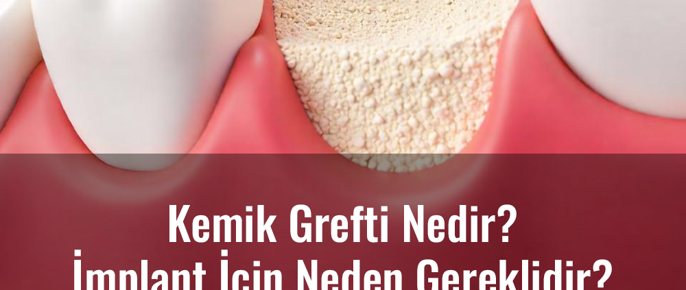 kemik grefti nedir? implant için neden gereklidir?