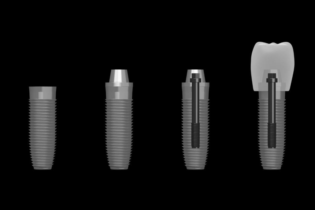 bir günde implant tedavisi, diş implantı, izmit implant tedavisi