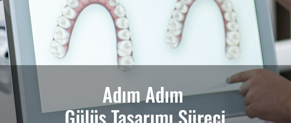adım adım gülüş tasarımı süreci, gülüş tasarımı nedir