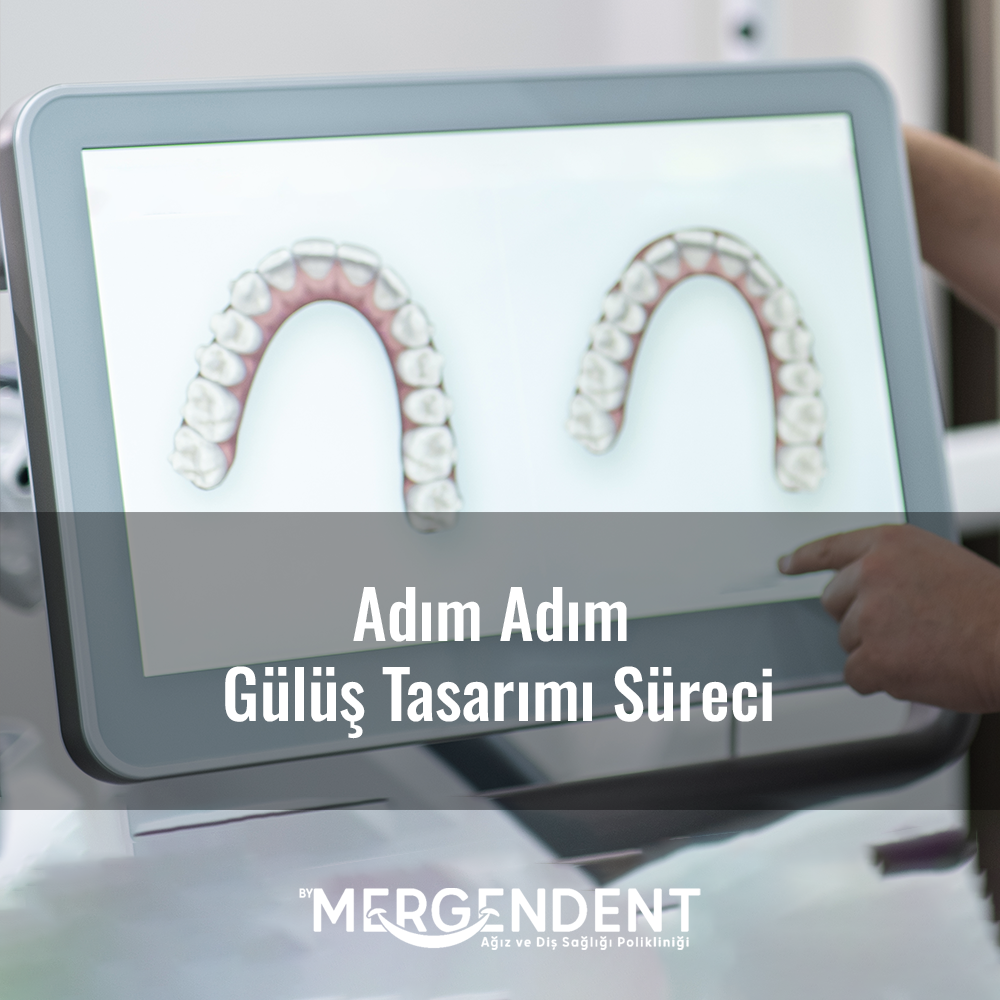 adım adım gülüş tasarımı süreci, gülüş tasarımı nedir