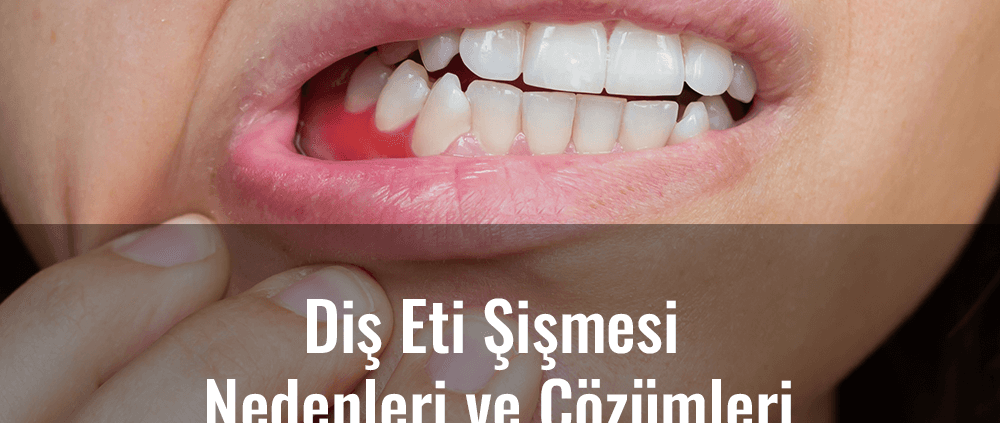 diş eti şişmesi nedenleri ve çözümleri