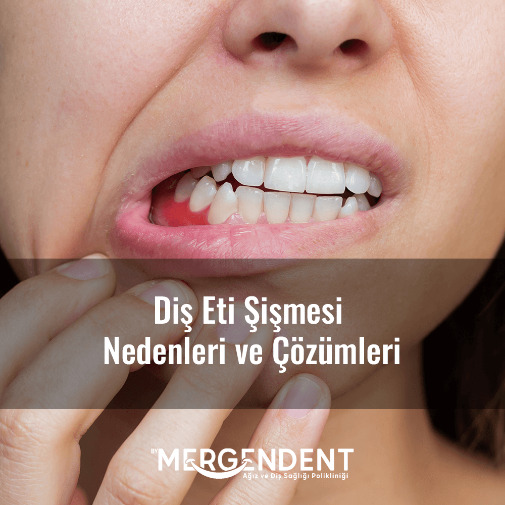 diş eti şişmesi nedenleri ve çözümleri