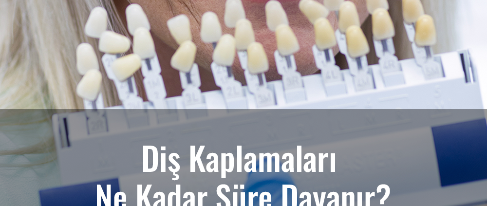 diş kaplamaları ne kadar süre dayanır?