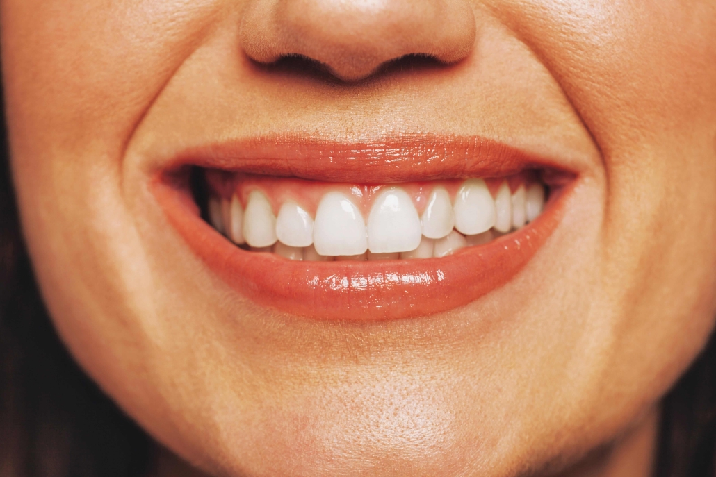 gülüş tasarımı süreci, gülüş tasarımı nedir