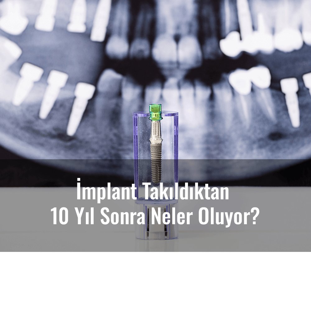 İmplant Takıldıktan 10 Yıl Sonra Neler Oluyor?