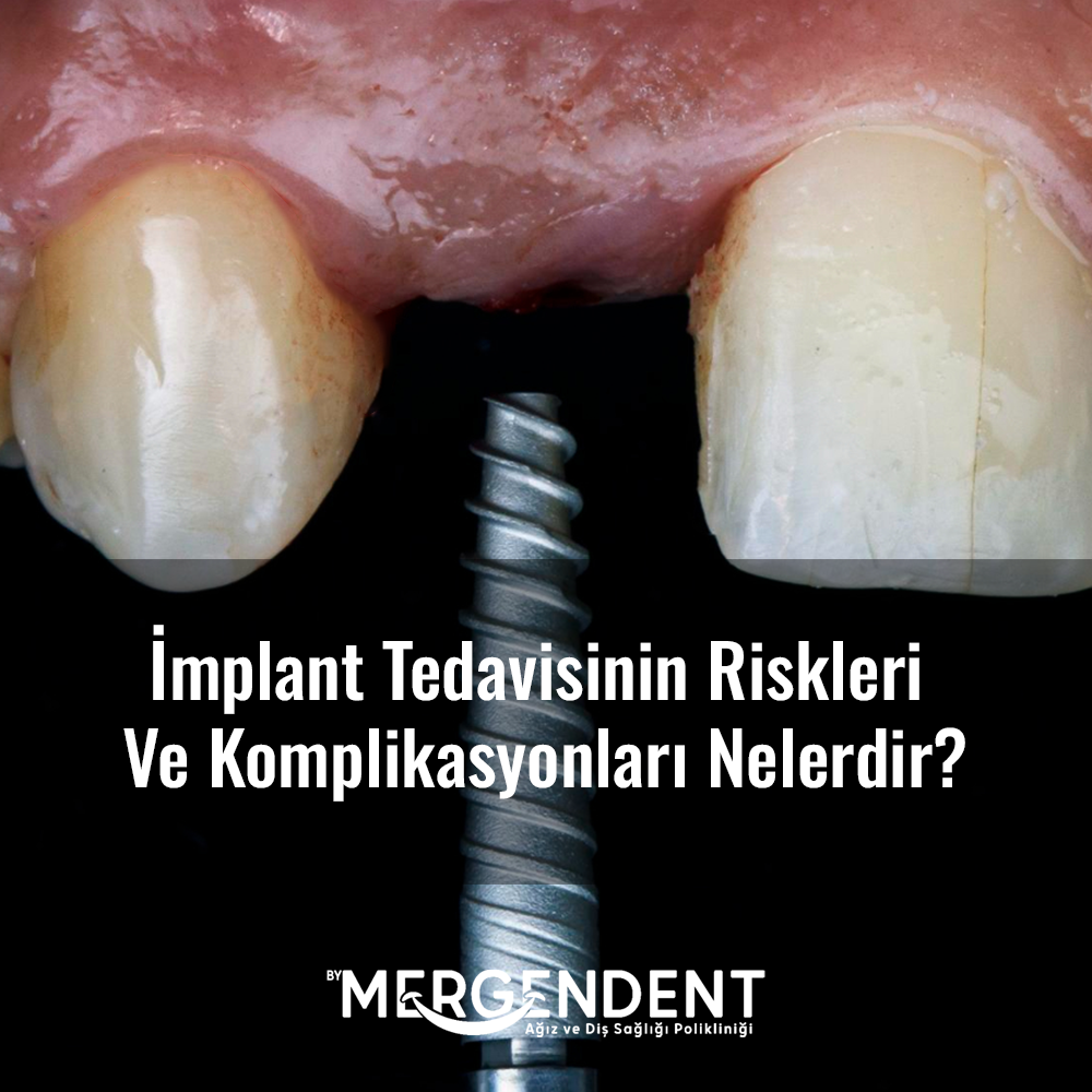 İmplant Tedavisinin Riskleri ve Komplikasyonları Nelerdir? , izmit implant tedavisi