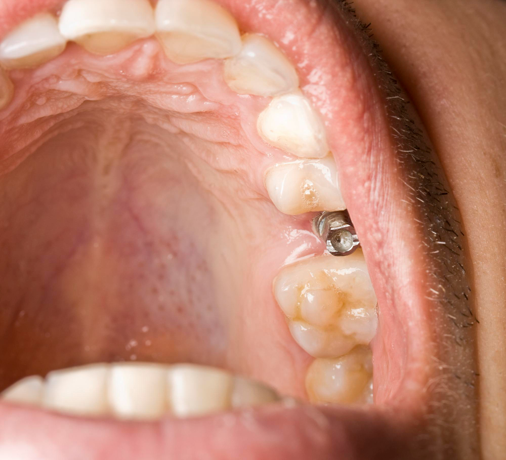 izmit implant tedavisi, implant tedavisi riskleri