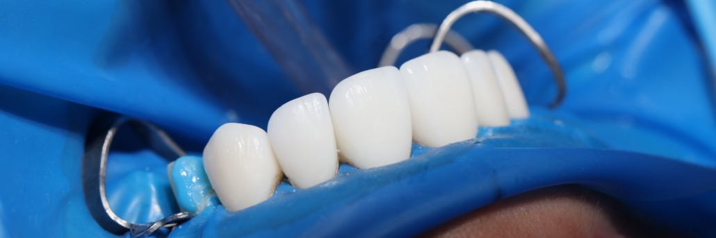 Diş Kaplamaları Ne Kadar Süre Dayanır? zirkonyum diş kaplaması, diş kaplamları ne kadar dayanır?