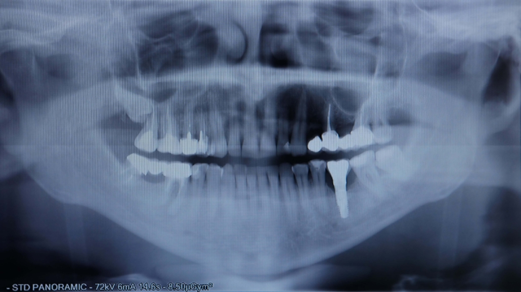 implantlar çene kemiğine zarar verir mi?